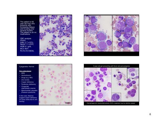 Myelodysplastic Syndromes