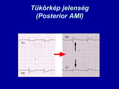 Acut coronaria syndroma (ACS)