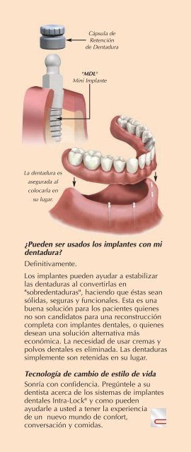 Dientes - Intra-Lock