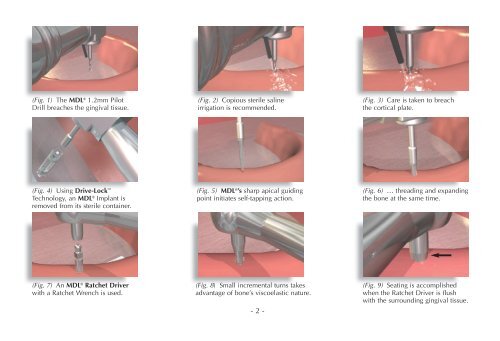 MDL® Surgical & Prosthetic Technique Manual - Intra-Lock