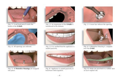 MDL® Surgical & Prosthetic Technique Manual - Intra-Lock