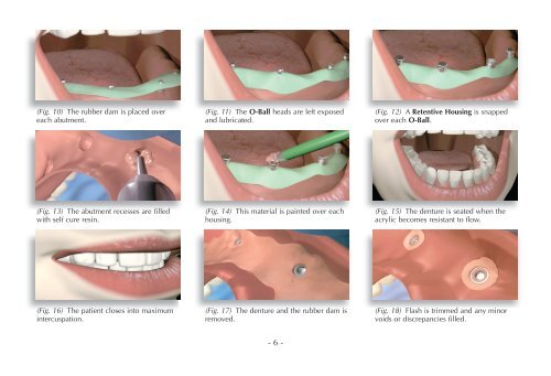 MDL® Surgical & Prosthetic Technique Manual - Intra-Lock