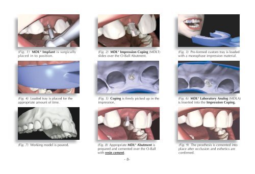 MDL® Surgical & Prosthetic Technique Manual - Intra-Lock