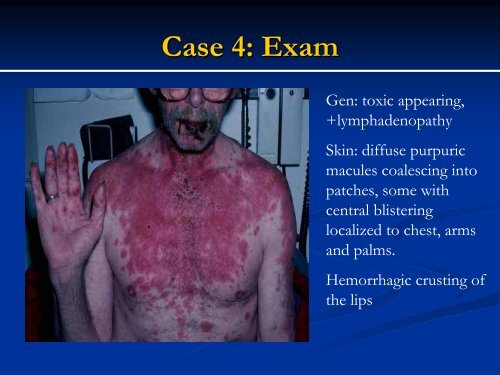 Urticaria - Dermatology