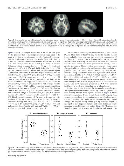 Preliminary Evidence for White Matter Tract Abnormalities in Young ...