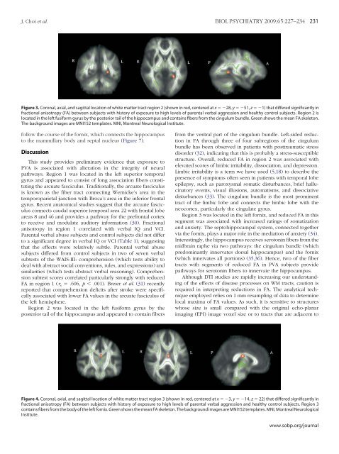 Preliminary Evidence for White Matter Tract Abnormalities in Young ...