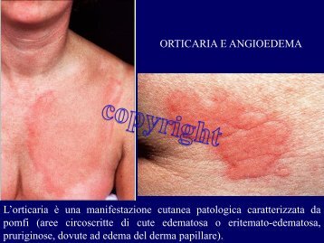 orticaria angioedema 2012 - Corso di laurea in tecniche della ...