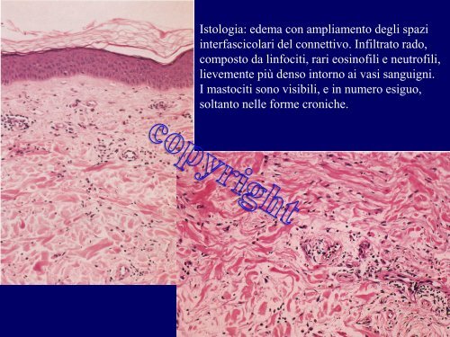 orticaria angioedema 2012 - Corso di laurea in tecniche della ...