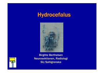 Hydrocefalus
