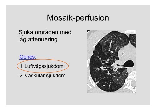 Interstitiella Lungsjukdomar