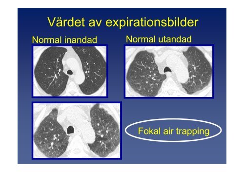 Generella lungsjukdomar