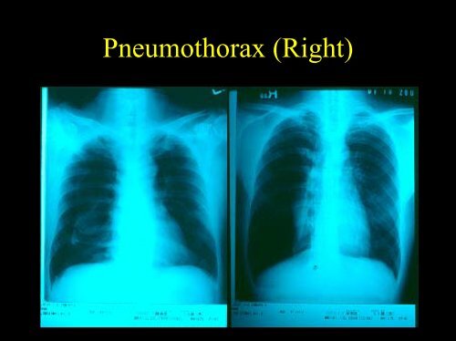 Pneumothorax and Chest Tube Problems