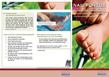 NAIL Fungus - ARC Laser