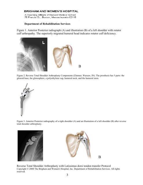 Reverse TSA with LDTT Protocol - Brigham and Women's Hospital