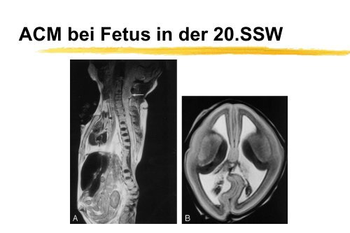 Klinische Symptome der Arnold-Chiari II ... - Die Asbh-Stiftung ist