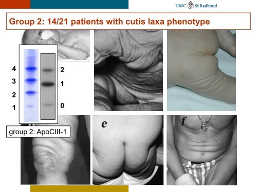 Congenital Disorders of Glycosylation: Diagnostic steps - ERNDIM