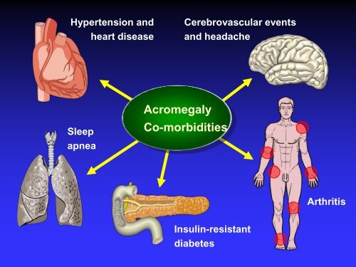 Acromegaly - The Annual Endocrine Society of Australia Seminar ...