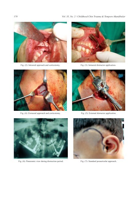 Childhood Chin Trauma and Temporo-Mandibular Joint ... - ESPRS