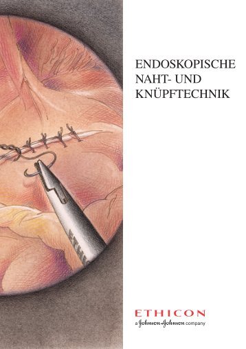 ENDOSKOPISCHE NAHT- UND KNÜPFTECHNIK - Ethicon