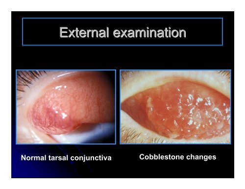 CLINICAL OPHTHALMOLOGY