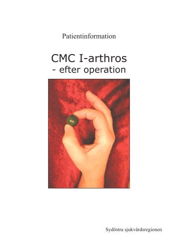 CMC-I-arthros, efter operation