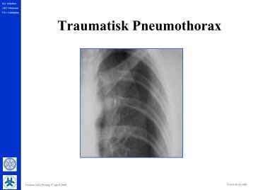 Traumatisk Pneumothorax.pdf