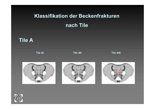 Klassifikation der Beckenfrakturen nach Tile