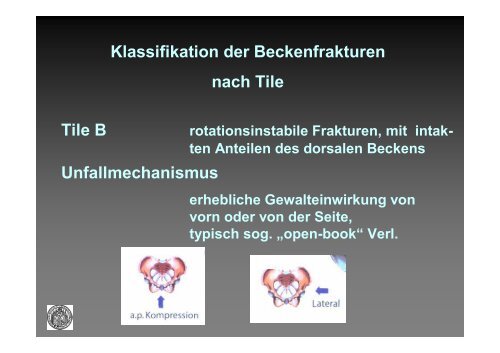 Klassifikation der Beckenfrakturen nach Tile