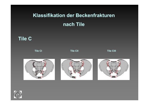 Klassifikation der Beckenfrakturen nach Tile