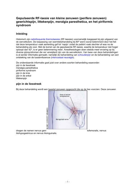 Gepulseerde RF-laesie van kleine zenuwen (perifere zenuwen)