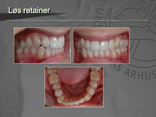 Nødbehandling af ortodontiske patienter