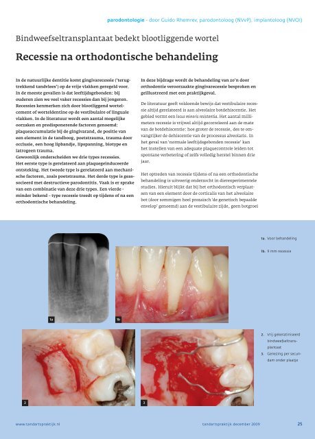 Recessie na orthodontische behandeling - Kliniek voor ...