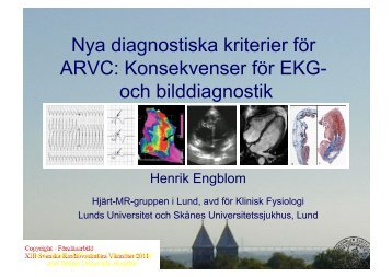 Nya diagnostiska kriterier för ARVC: Konsekvenser för EKG- och ...
