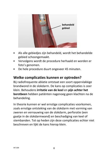 Radiofrequente ablatie bij een Barrett slokdarm - IJsselland ...