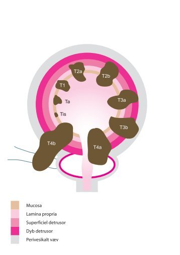 Mucosa Lamina propria Superficiel detrusor Dyb detrusor ...