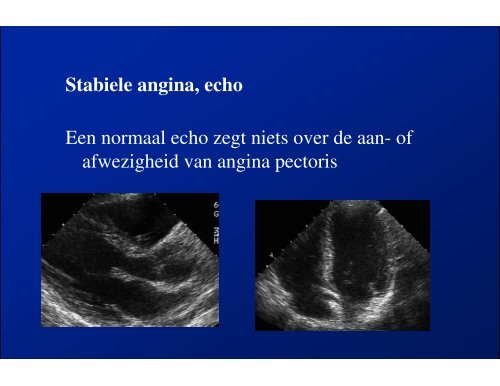 ACUTE CORONAIRE SYNDROMEN - ICverpleegkundige.com