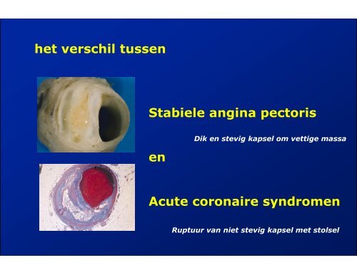 ACUTE CORONAIRE SYNDROMEN - ICverpleegkundige.com