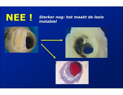 ACUTE CORONAIRE SYNDROMEN - ICverpleegkundige.com