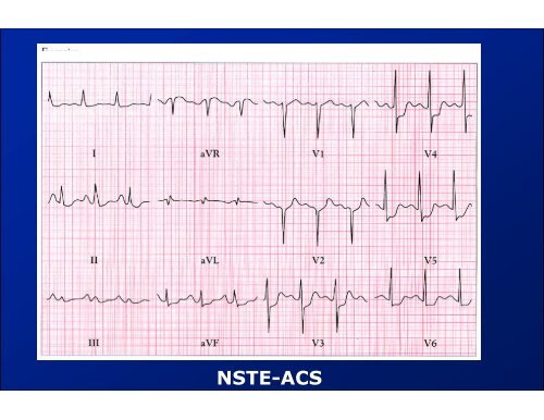 ACUTE CORONAIRE SYNDROMEN - ICverpleegkundige.com