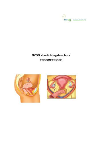 NVOG Voorlichtingsbrochure ENDOMETRIOSE