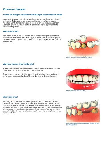 Kronen en bruggen - Medi Mondzorg