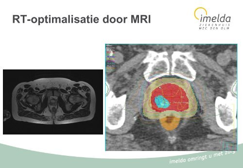 06 - Urologie - prostaatcarcinoma - Imelda