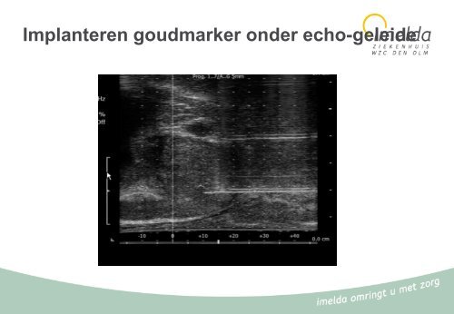 06 - Urologie - prostaatcarcinoma - Imelda