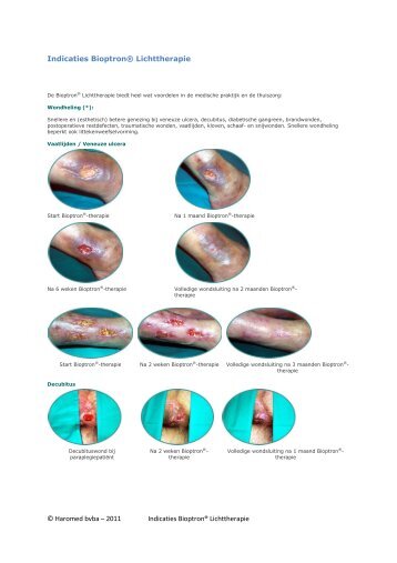 © Haromed bvba – 2011 Indicaties Bioptron® Lichttherapie ...