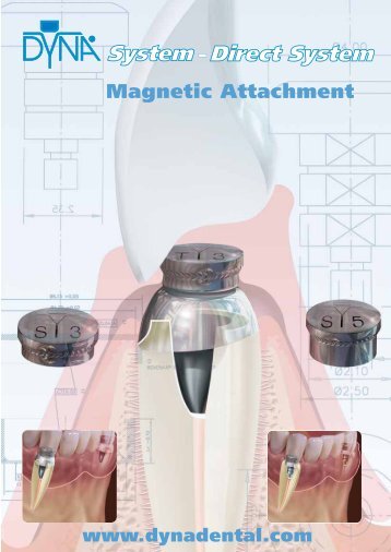 Magnetic Attachment - Dyna Dental