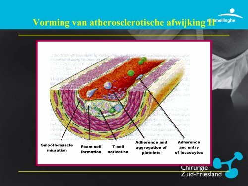 Perifeer Arterieel Vaatlijden - Vaatchirurg