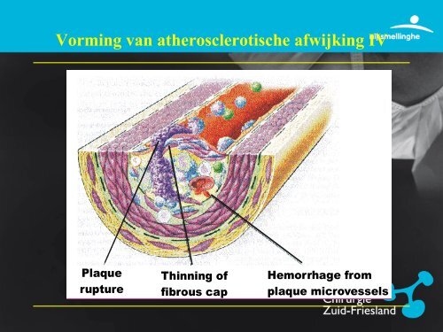 Perifeer Arterieel Vaatlijden - Vaatchirurg