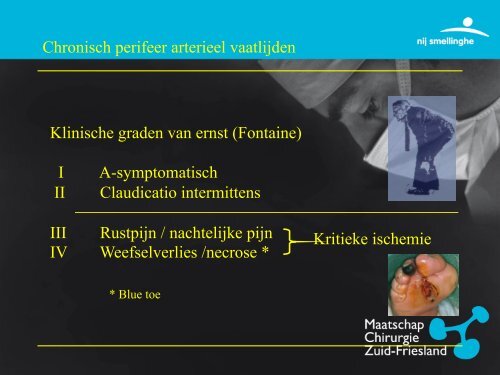 Perifeer Arterieel Vaatlijden - Vaatchirurg