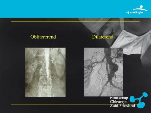 Perifeer Arterieel Vaatlijden - Vaatchirurg