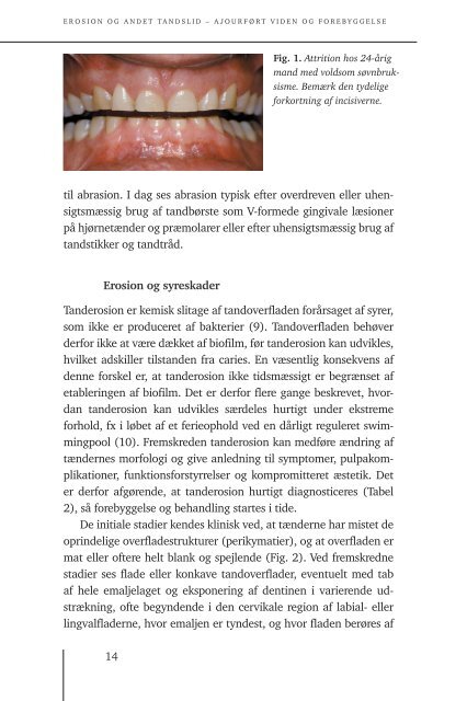 Erosion og andet tandslid - Aktuel Nordisk Odontologi - Munksgaard